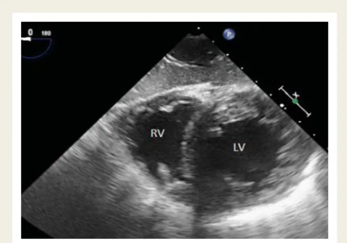 Figure 14 Transgastric two-chamber view. The apex is to the left, and the left atrium to the right in the image