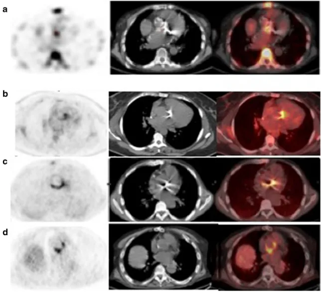 Fig. 5 Examples of different patterns of 99m Tc-HMPAO WBC and [ 18 F]FDG uptake in patients with confirmed PVE: a typical focal pattern at 99m Tc-HMPAO WBC imaging; b focal pattern of [ 18 F]FDG;
