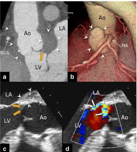 Fig. 8 A 52-year-old man with prosthetic aortic valve endocarditis (coagulase-negative staphylococci) 4 years after aortic root replacement with a 25-mm Freestyle biological valve, replacement of the ascending aorta with a 28-mm Dacron graft and reconstruc