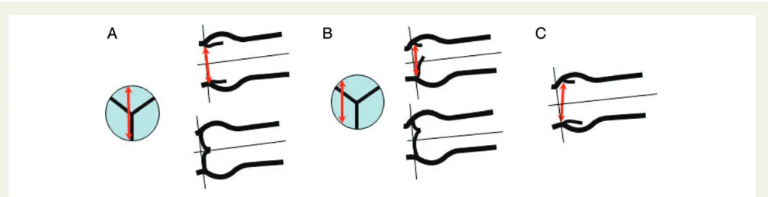 Figure 12 Correct (A) and incorrect (B, C) measurements of the aortic annulus (double arrows)