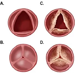 Figure 1.8. Schéma représentant une valve aortique normale et une valve aortique avec sténose  aortique calcifiante 