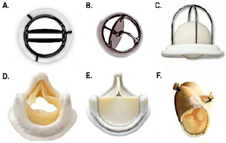 Figure 1.11. Différents types de prothèses valvulaires 