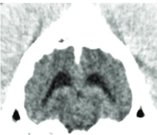 Figure 2: Transverse CT image of the brain, 30 days later, showing the absence of the lesion and the almost complete resolution of the ventricular enlargement.