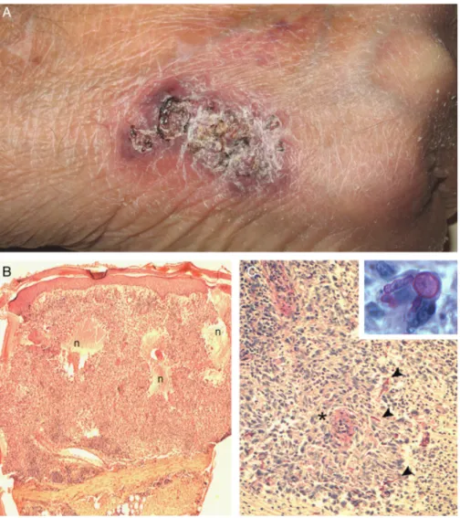 Fig. 1 . Cutaneous alternariosis. (A) Clinical examination: a scaly violaceous plaque on the back of the right hand