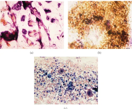 Figure 8: Epithelial neoplasms. (a) Seborrheic keratosis. (b) Malignant melanoma. (c) Carcinoma of the genital area.