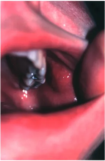 Figure 1 Post-toxic epidermal necrolysis duct cyst of the parotid.