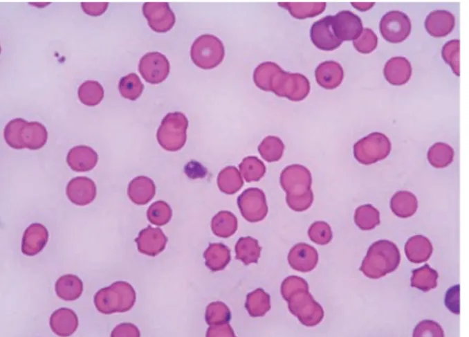 Figure 2 Merozoites within red blood cells in a cat from Trieste (Italy). Courtesy of Dr Erika Carli and Dr Laia  Solano-Gallego, Clinica Veterinaria Privata San Marco, Padova, Italy Cat-to-cat transmission of cytauxzoonosis has never  been proven.Diagnosi