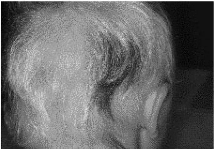 Fig. 3. Plaque de pelade avec cheveux &#34;en point d’exclamation&#34;