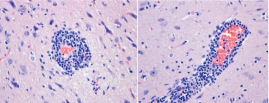 Fig 1: Histopathology of the brain of a canine distemper virus-infected raccoon  from Liège, showing non-suppurative meningoencephalitis with prominent  perivascular cuffing