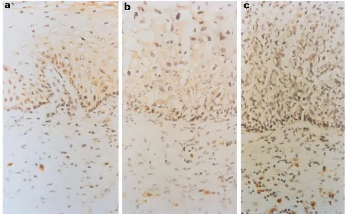 Fig. 2. Detection of IL-12 protein in squamous intraepithelial lesions (SIL). Immunohistochemical staining for IL-12: (a) normal exocervix, (b) low-grade SIL, and (c) high-grade SIL