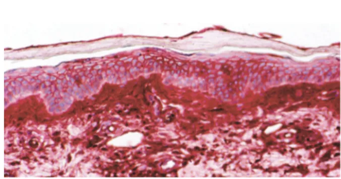 Figure 1. Macule érythémateuse infiltrée, purpurique et squameuse du rash  de l’influenza A H 1 N 1 .