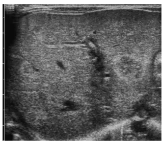 Figure 1 Choriangiome et ascite.