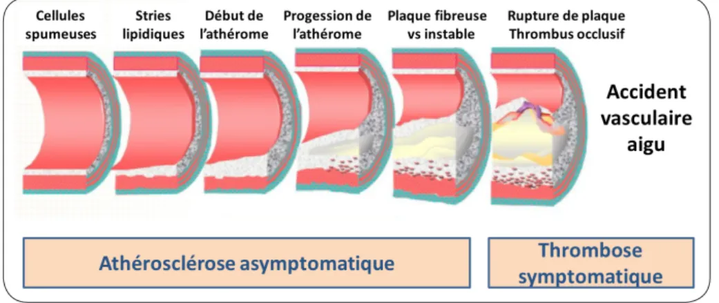 Figure 2. Histoire naturelle de l’athérosclérose, longtemps silencieuse, conduisant à  une thrombose occlusive et à un accident aigu