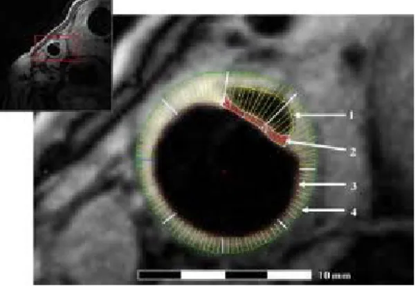 Figure 5: Coupe transversale en imagerie par résonance magnétique de la paroi artérielle  carotidienne 