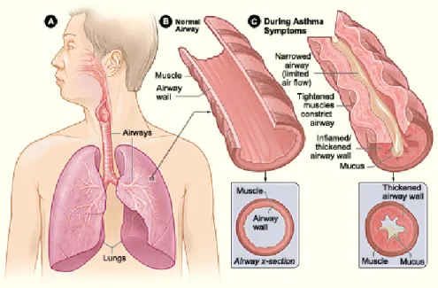 Figure 1.1: Comparison of normal and asthmatic airways. Section A shows the position of the lungs and the airways in the body