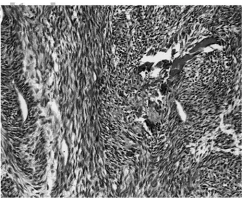 FIGURE 1. Case 1. Fascicular spindle cell proliferation with scattered minute dystrophic calcifications