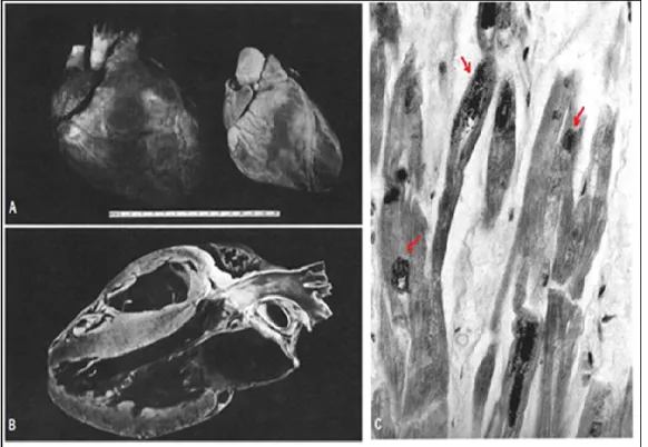 Figure 2 : Hypertrophie cardiaque dans FRDA 