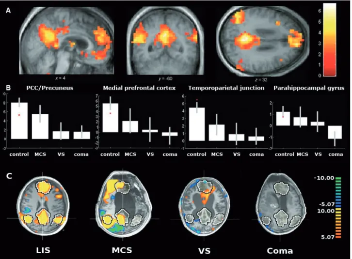 Fig.  1.  -  Default  mode  network  connectivity  in  patients  with  disorders  of  consciousness