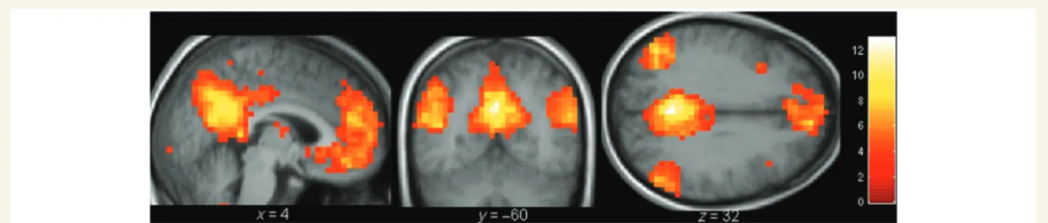 Table 2 Peak voxels of the default network identified in healthy volunteers