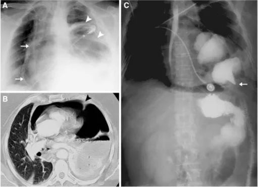 Fig. 1 a Thoracic conventional radiography showing a  pneumo-pericardium (arrows), as well as bowel structures in the left hemithorax (arrowheads)