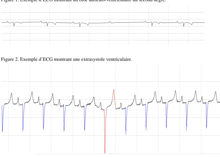 Figure 1. Exemple d’ECG montrant un bloc auriculo-ventriculaire du second degré. 