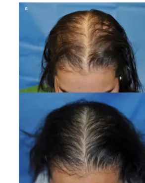 Figure 4 a, b. Résultats cliniques avant et après traitement (26 semaines) par LLLT de type HAIRMAX® :  chez un homme (a, photographie fournie par le  fabricant)  et chez une femme (b, d’après 1)