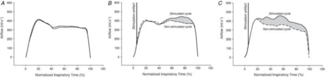 Figure 8. Effets de la SMT lors du sommeil sur le volume et le débit inspiratoire 36 