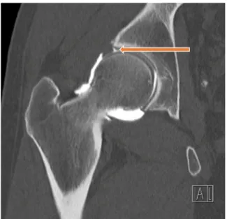 Figure 2. Arthroscanner : ﬁ ssuration du pôle supérieur du labrum.