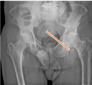 Figure 9. IRM : avulsion du petit trochanter droit déplacée vers le haut.