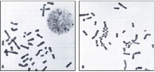 Figure 5: Étalement de lymphocytes caractéristique de l'anémie de Fanconi 