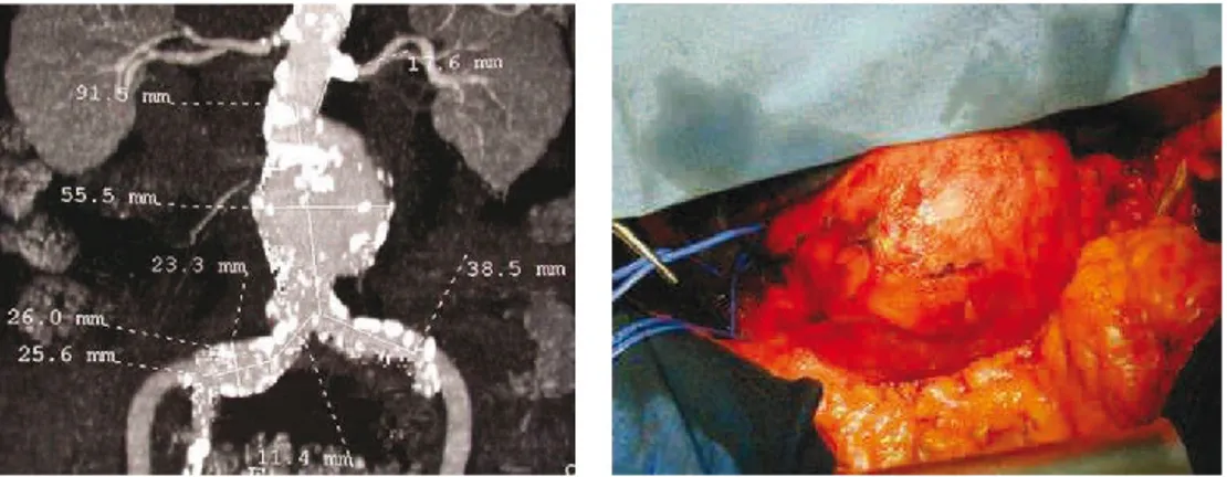 Figure 10.   Anévrisme de l’aorte abdominale [49] 