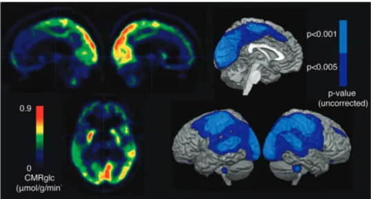 Figure 2. Metabolic differences between 14 patients in VS/UWS and 21 patients in MCS. Left: subtraction of average VS/UWS image from average MCS image