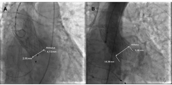 Fig. 1. Angiography in LAO of a fully deployed CoreValve after a high (A) and a low (B) implantation beneath the aortic annulus