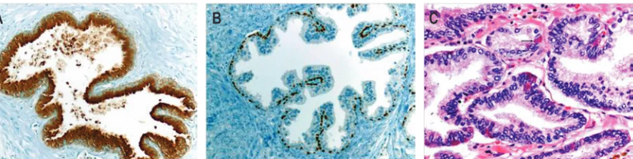 Figure 1. Représentation des différents types cellulaires de la prostate humaine par immunohistochimie