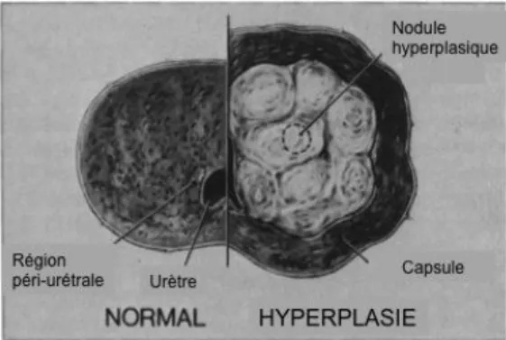 Figure 9. Représentation grossière d'un cas  d'obstruction urinaire dû au BPH. 