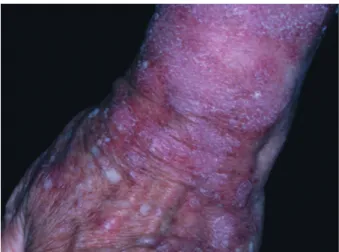 Fig. 1 : Lupus érythémateux révélé par un médicament photosensi- photosensi-bilisant