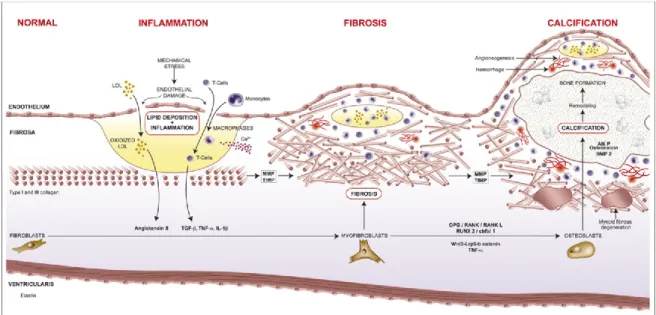 Figure  4  :  Résumé  des  processus  pathologiques  qui  surviennent  dans  la  valve  lors  d’une  sténose  aortique