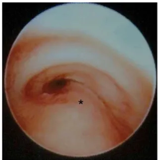 Figure 6. A) Anatomie d’un patient avec une crosse aortique droite, une artère sous-clavière gauche rétro-oesophagienne et un large diverticule de Kommerell  (DK)