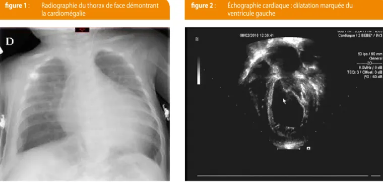 figure 1 :   Radiographie du thorax de face démontrant 