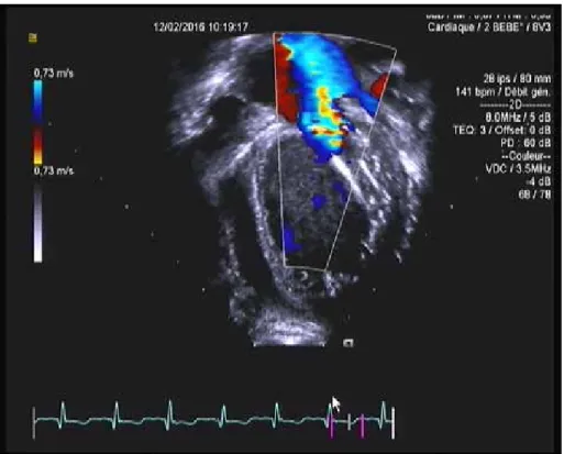 figure 3 :    Doppler couleur : insuffisance mitrale majeure