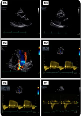 Figure 1. Exploration de l’insuffisance aortique et de ses répercussions en   échocardiographie transthoracique
