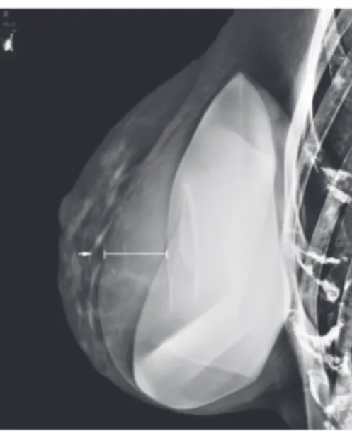 Figure 1: Mediolateral oblique view of the right breast shows a rim of density surrounding the silicone implant (white arrow).