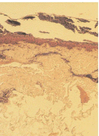 Fig. 1. Pustulose sous cornée de Sneddon et Wilkinson. Placards érythémateux circinés parsemés de pustules, au niveau de la fesse et de la cuisse.
