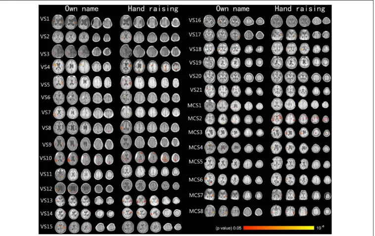 FIGURE 1 | Shows the activation of the auditory cortex caused by own name stimulation and activation of the motor-related cortex caused by the hand-raising command in 29 DOC patients (axis view, p &lt; 0.05, corrected).