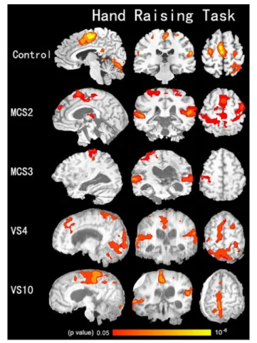 FIGURE 2 | Shows activation in the auditory cortex, the motor-related cortex (the supplementary motor cortex, primary motor cortex, anterior cingulated cortex, and the cerebellum) during the hand-raising task in two VS/UWS patients, two MCS patients, and 1