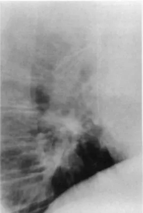 Fig. 2. Chest x-ray film (lateral view) showing migration of vena caval filter into the bifurcation of the  pulmonary artery