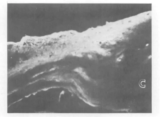 Fig. 6. Fluorescence micrograph of a normal sclerocorneal section reacted with anti—type III antibodies reveals strong fluorescence in Tenon's and the sclera at the liinbal transition zone.