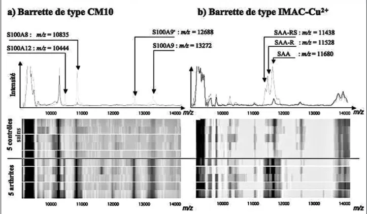 Figure 2. Profils protéiques obtenus sur deux types de surface chromatographique (CM10 et IMAC-Cu2+) à partir d’échantillons sériques provenant de 5 patients  atteints de maladies non inflammatoires (dont l’arthrose) (trait noir sur le spectre) et 5 patien