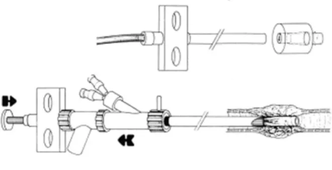 Fig. 1. Schéma illustrant la technique de mise en place de la prothèse en silicone de Dumon.