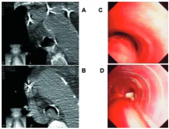 Fig. 5. Trachéomalacie « Floppy membrane type » confirmée par scanner thoracique et endoscopie bronchique (A, B, C), amélioration après mise en place d’une prothèse en Y du Dr Freitag (D).